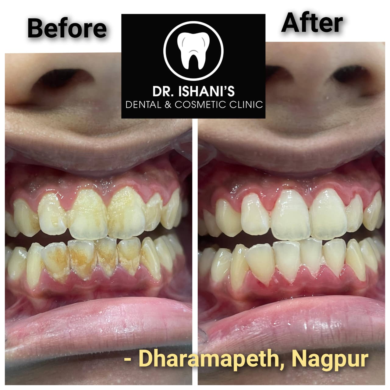 Before and after dental treatment - Dharampeth Nagpur