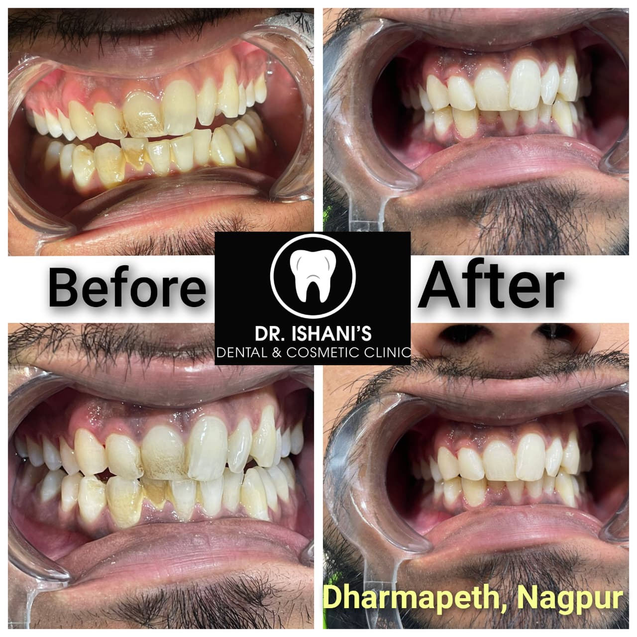 Before and after teeth cleaning - Dharampeth Nagpur